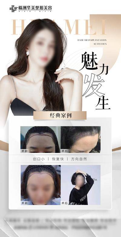 【南门网dcpsd.com】医美 高端 魅力 植发 发生 案例 对比 创伤 恢复 快 自然 方向 经典 线条