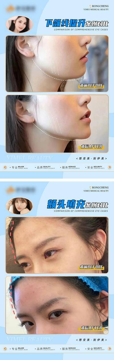【南门网dcpsd.com】广告 海报 医美 案例 对比 提升 埋线