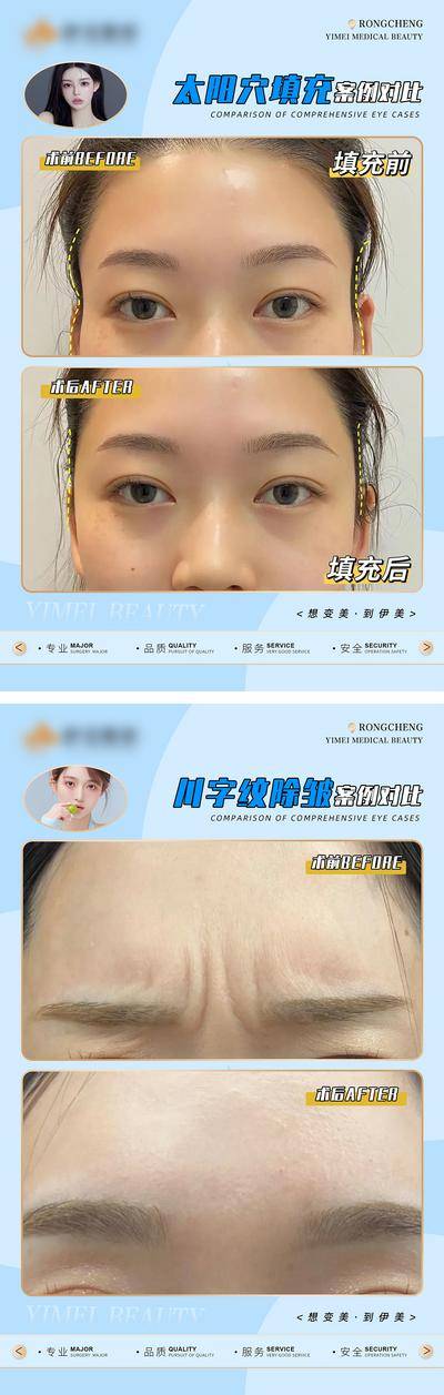 【南门网dcpsd.com】广告 海报 医美 案例 对比 填充 除皱