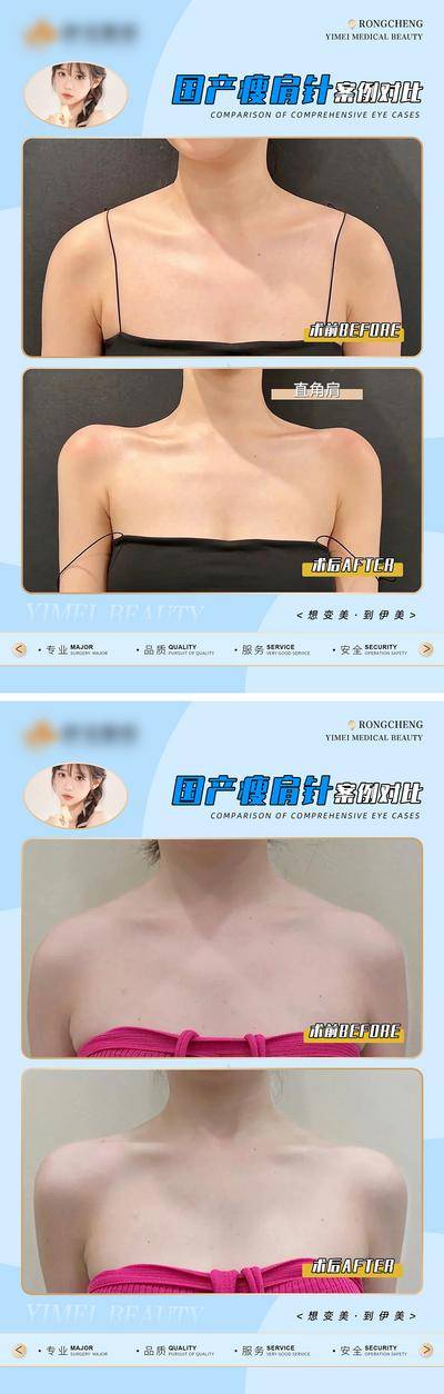 【南门网dcpsd.com】广告 海报 医美 案例 对比 瘦肩