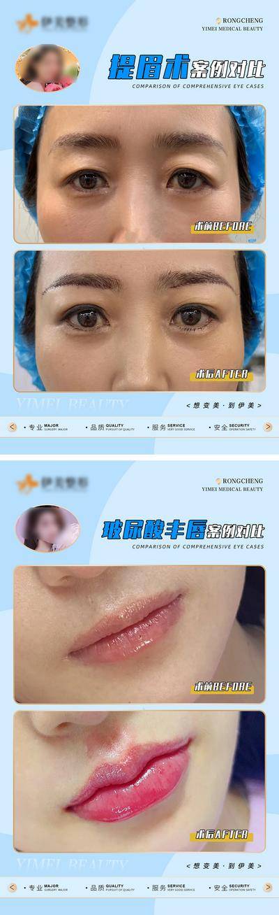 【南门网dcpsd.com】广告 海报 医美 对比 案例 眉毛 玻尿酸 唇