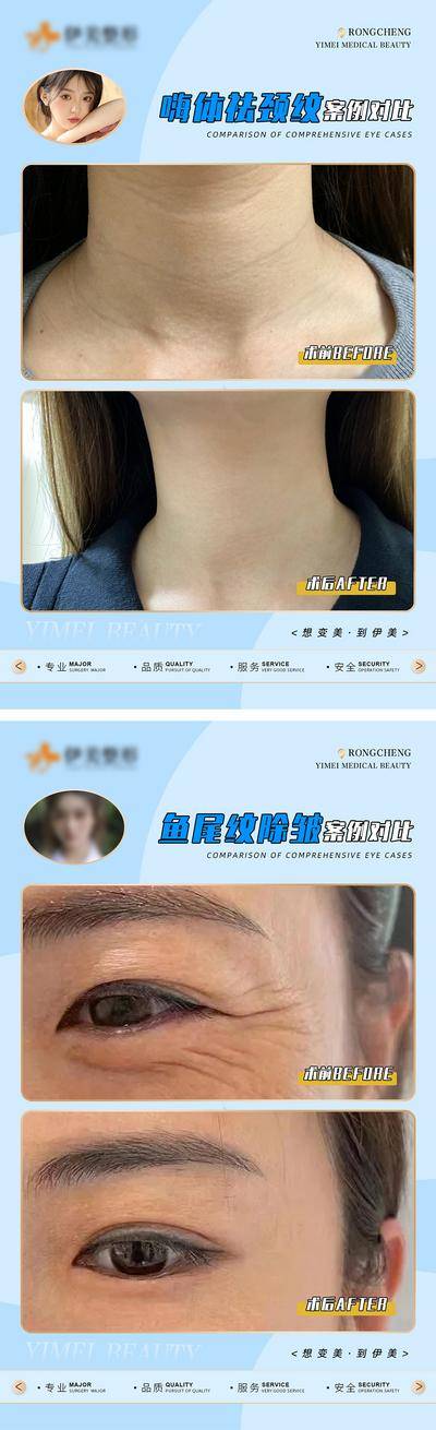 【南门网dcpsd.com】广告 海报 医美 对比 案例 祛斑 除皱 鱼尾纹 唇