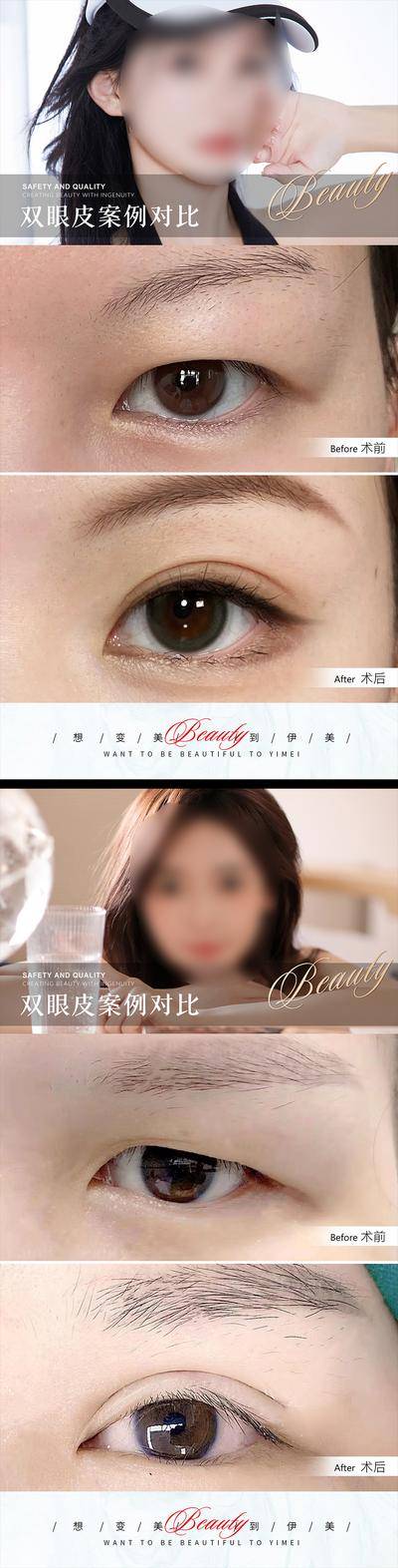 【南门网dcpsd.com】广告 海报 医美 案例 整形 对比 系列 双眼皮