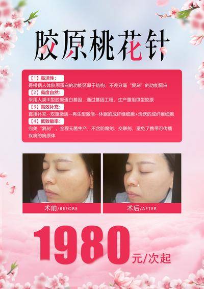 【南门网dcpsd.com】广告 海报 医美 台卡 胶原 桃花 针 高效 效率 功效 案例 对比 价格 粉色 优点 术前 术后