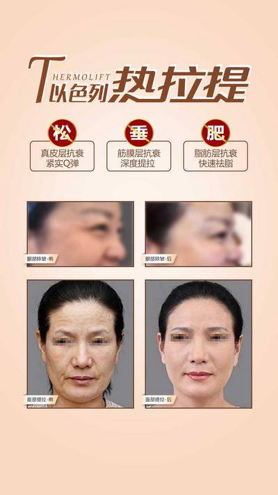 【南门网dcpsd.com】广告 海报 医美 热拉提 仪器 优点 展示 除皱 全面部 肌肤 弹性 抗衰 案例 对比 松垂拉 q弹