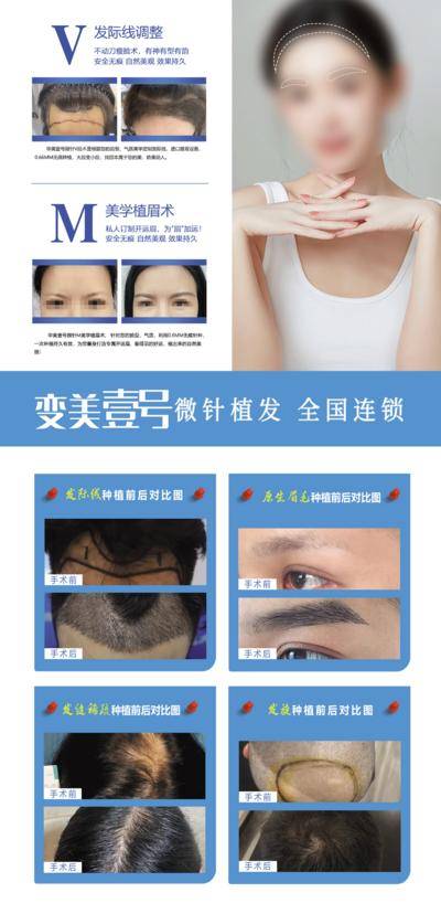 【南门网dcpsd.com】广告 医美 微针 植发 全国 连锁 案例 对比 发际线 眉毛 美学 效果 持久 进口 设备 无痕 安全 自然 美观 手术